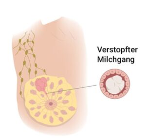 Milchstau